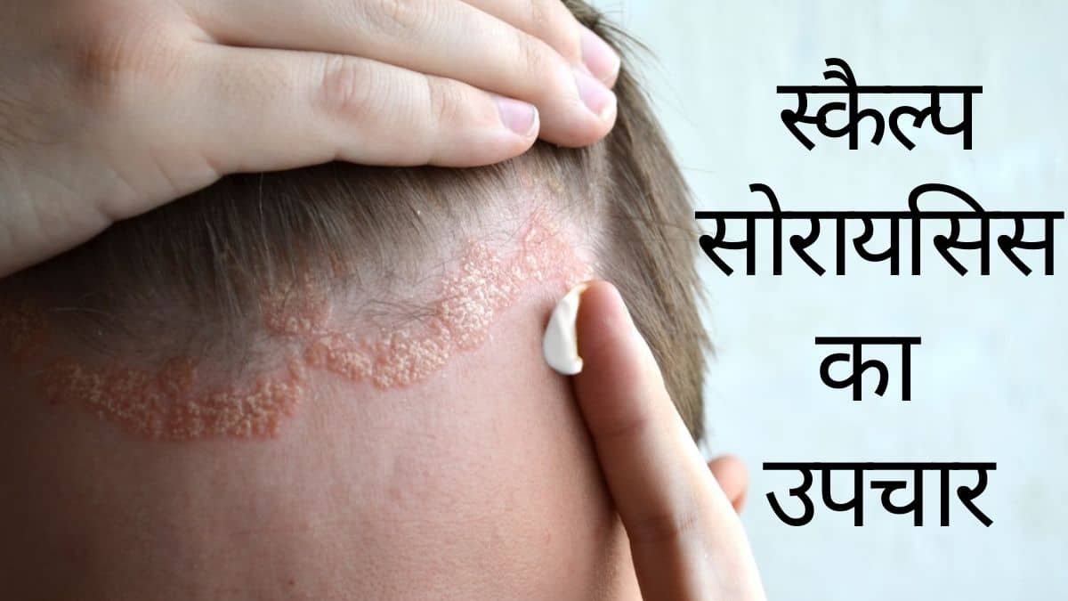 Scalp Psoriasis Treatment In Hindi स क ल प स र यस स क उपच र और र कथ म Thehealthsite Com ह द
