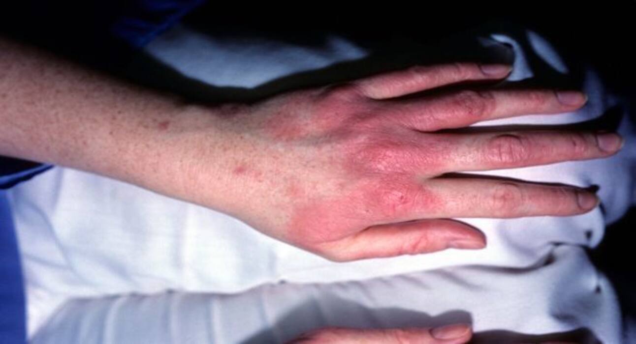 Litchi Side Effects: एक बार में खा जाते हैं 20-30 लीची, तो कंट्रोल कर लें खुद पर वरना...