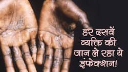 what is monkeypox infection : 18 से 40 साल वाले हो जाए सावधान! आ गया नया इंफेक्शन, हर दसवें व्यक्ति की लेता है जान
