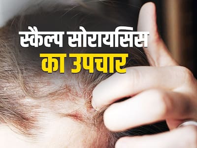 Scalp Psoriasis Treatment In Hindi | स्कैल्प सोरायसिस का उपचार और