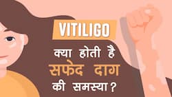 30 की उम्र से पहले ही हो जाती है सफेद दाग की समस्‍या, डॉक्‍टर से जानिए क्‍यों होते हैं सफेद दाग