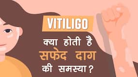 30 की उम्र से पहले ही हो जाती है सफेद दाग की समस्‍या, डॉक्‍टर से जानिए क्‍यों होते हैं सफेद दाग