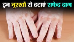 Home Remedies For White Spot: सीनियर डॉक्‍टर ने बताया सफेद दाग के लिए घरेलू नुस्खा, एकदम गायब हो जाता है दाग