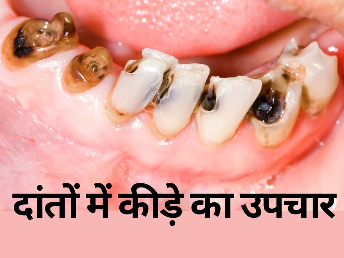Cavitie Tooth Decay In Hindi