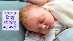 Cradle Cap in Babies: नवजात के सिर में पपड़ी जमने को कहते हैं क्रेडल कैप, जानिए शिशु के सिर पर पीली पपड़ी के कारण