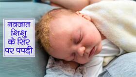 Cradle Cap in Babies: नवजात के सिर में पपड़ी जमने को कहते हैं क्रेडल कैप, जानिए शिशु के सिर पर पीली पपड़ी के कारण