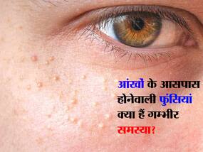 Milia Symptoms, Causes And Treatment: क्या आंखों के आस-पास दिखने लगे हैं ‘स्किन टैग्स’ ?, जानें कितनी गम्भीर है ये बीमारी और क्या है इसका उपाय