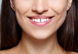 Gap Between Front Teeth: Know The Best Methods To Fix It Without Braces