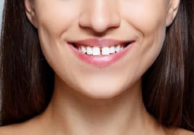 Gap Between Front Teeth: Know The Best Methods To Fix It Without Braces Gap Between Front Teeth: Know The Best Methods To Fix It Without Braces