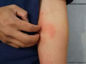 Unusual Post-COVID Complication: Man Develops Rare Skin Infection After Recovery, Know Everything About It