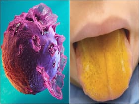 Epstein Barr Virus Found In Canada Can Turn Your Tongue Yellow: Know Everything