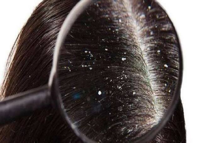 Why is my hair falling out? Dr Rashmi Shettyra gives 5 reasons ...