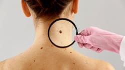 Why Moles Sometimes Become Melanomas?
