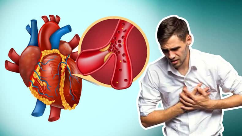 myocardial-infarction