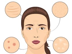 Face Mapping: What Your Acne Is Telling You About Your Health?