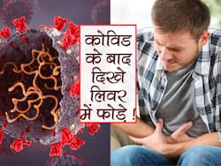 दिल्ली में 14 लोगों में दिखे कोविड रिकवरी के बाद फेफड़ों में दिखे फोड़े