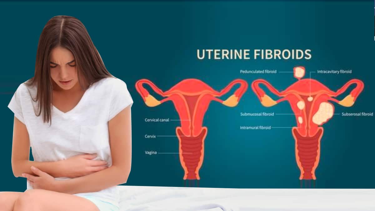 Uterus Saving Non Surgical Treatment For Fibroids Thehealthsite Com