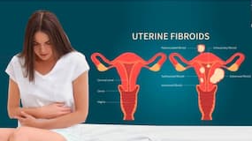 Uterus saving non-surgical treatment for fibroids