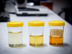 рдкреЗрд╢рд╛рдм рдХрд╛ рд░рдВрдЧ рдкреАрд▓рд╛ рд╣реЛрдиреЗ рдХреЗ рдХрд╛рд░рдг