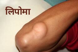 Lipoma Treatment In Ayurveda: जानिए लिपोमा के आयुर्वेदिक उपचार