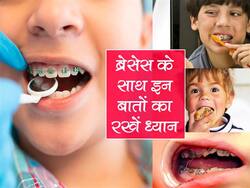 Care Tips For Children With Braces: अगर बच्‍चे के दांतों में लगी है तार तो ध्‍यान रखें ये 5 बातें, बिल्‍कुल नहीं होगा ओरल इंफेक्‍शन