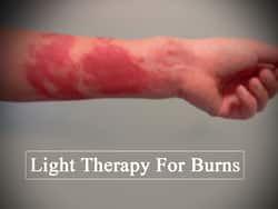 Light Therapy Shows Promising Results For Treating Burn Injuries