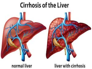 Symptoms of Liver Cirrhosis: लिवर सिरोसिस के इन 5 शुरुआती लक्षणों को नजरअंदाज किया तो जा सकती है जान
