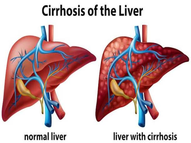 Cirrhosis: Symptoms, Causes, Diagnosis, and Treatment