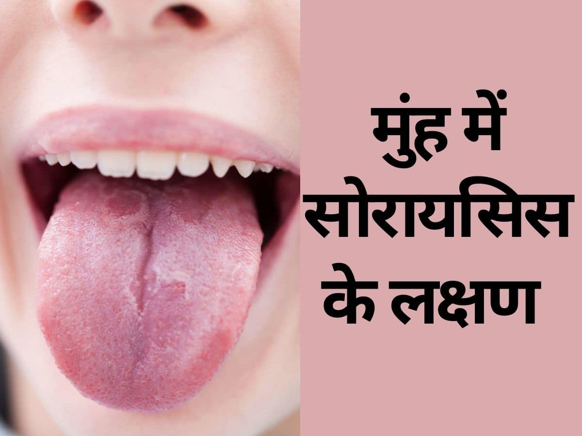 Oral Psoriasis ज भ म द खन व ल य 6 लक षण ओरल स र यस स क ह स क त ज न ए उपच र और बच व Thehealthsite Com ह द