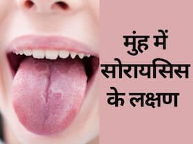 Oral Psoriasis: जीभ में दिखने वाले ये 6 लक्षण ओरल सोरायसिस के हैं संकेत, जानिए उपचार और बचाव