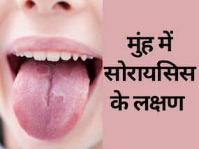 Oral Psoriasis: जीभ में दिखने वाले ये 6 लक्षण ओरल सोरायसिस के हैं संकेत, जानिए उपचार और बचाव
