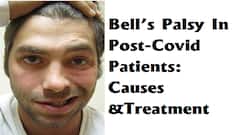 Cases of Facial Paralysis in Post-Covid Patients Increasing: What You Need To Know