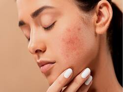 Looking For Ways To Tackle Hormonal Acne? Expert Suggests 4 Quick Home Remedies