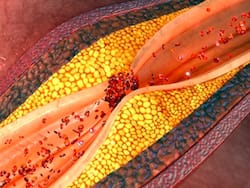 More Than 40% Of Adults With No Known Heart Disease Show Signs Of Atherosclerosis