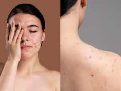 Are You Undergoing Acne Treatment? Here are Some Dos and Don   ts You Should Follow