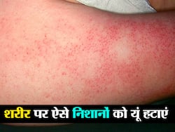 Home remedies for Chicken skin in hindi : स्किन पर मुर्गे की स्किन जैसे निशान से परेशान? डॉक्टर के बताए ये 8 टिप्स करें फॉलो और पाएं आराम