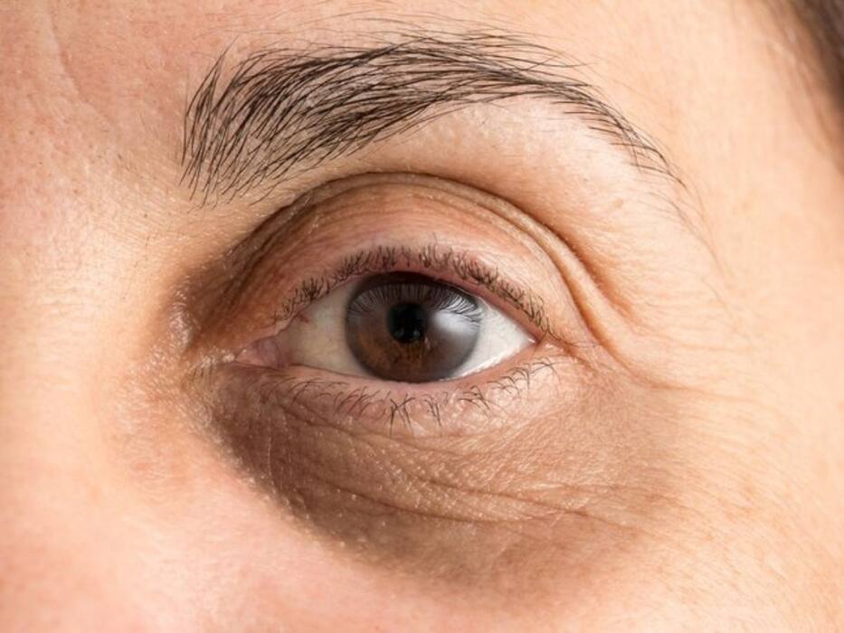 Dark Circles Under The Eyes: डार्क सर्कल 3 तरह के होते हैं, एक्सपर्ट से जानिए इनके कारण, लक्षण और बचाव