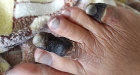 Arterial Thrombosis in Post-Covid Patients: It Can Cause Limb Amputation, Death