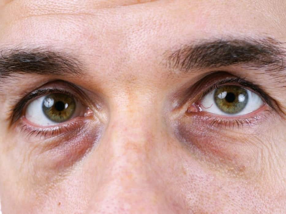 Dark Circles Under The Eyes: डार्क सर्कल 3 तरह के होते हैं, एक्सपर्ट से जानिए इनके कारण, लक्षण और बचाव