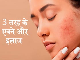 तीन तरह के होते हैं मुंहासे! जानें आपको हुआ है कौन सा वाला मुंहासा और उनसे छुटकारा पाने के तरीके तीन तरह के होते हैं मुंहासे! जानें आपको हुआ है कौन सा वाला मुंहासा और उनसे छुटकारा पाने के तरीके