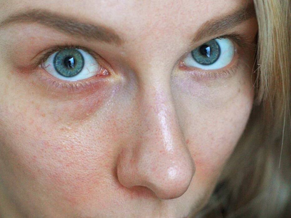 Dark Circles Under The Eyes: डार्क सर्कल 3 तरह के होते हैं, एक्सपर्ट से जानिए इनके कारण, लक्षण और बचाव