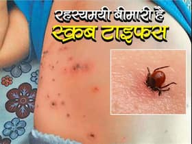 Scrub Typhus In Uttar Pradesh: यूपी में मिले स्क्रब टाइफस के 60 से भी ज्यादा केस, जानिए कैसे फैल रही है ये रहस्यमयी बीमारी Scrub Typhus In Uttar Pradesh: यूपी में मिले स्क्रब टाइफस के 60 से भी ज्यादा केस, जानिए कैसे फैल रही है ये रहस्यमयी बीमारी