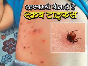 Scrub Typhus In Uttar Pradesh: यूपी में मिले स्क्रब टाइफस के 60 से भी ज्‍यादा केस, जानिए कैसे फैल रही है ये रहस्‍यमयी बीमारी