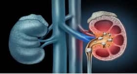Lifestyle Changes You Should Make To Prevent Kidney Stones Lifestyle Changes You Should Make To Prevent Kidney Stones