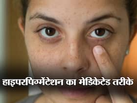 हाइपरपिगमेंटेशन का सस्ता और टिकाऊ इलाज हैं ये कॉम्बिनेशन, जानें काली स्किन को साफ करने के कुछ मेडिकेटेड टिप्स