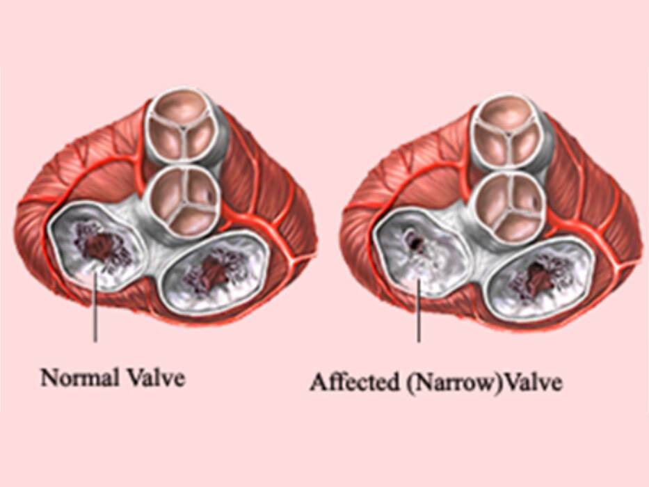 World Heart Day 2021: भारतीयों में बहुत ही कॉमन हैं ये 5 हृदय रोग, जो बनते हैं मौत का कारण; विस्तार से जानिए