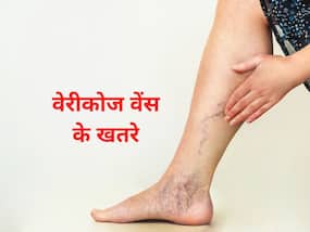 Varicose Veins Complications: त्वचा पर दिखने वाली टेढ़ी-मेढ़ी नसों को नजरअंदाज करना पड़ सकता है भारी, आप इन 9 समस्याओं के हो सकते हैं शिकार