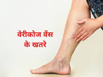 Varicose veins - Health Tips in Hindi, Varicose veins Health Articles,  Health News in Hindi