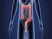 Colorectal Cancer Cases On Rise Among Young Adults In India: Rare and Unusual Symptoms You Need To Know