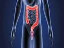 Colorectal Cancer Cases On Rise Among Young Adults In India: Rare and Unusual Symptoms You Need To Know